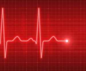 Atrial Stenosis